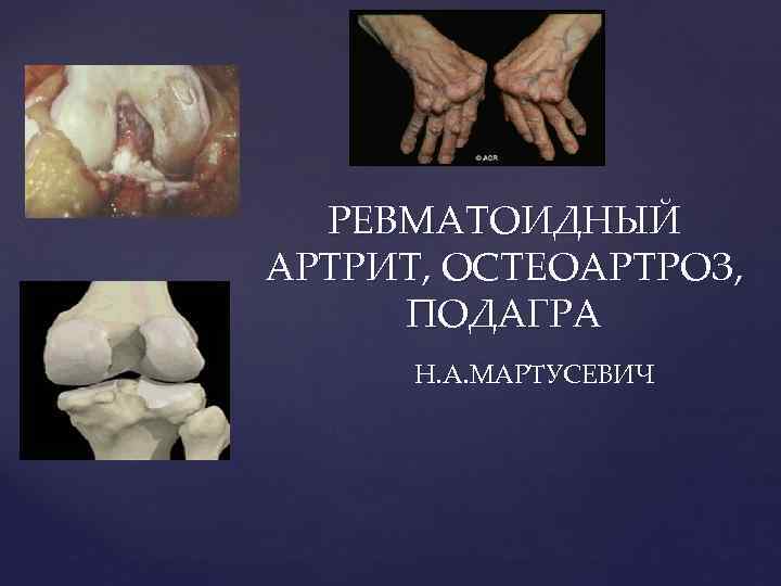 { РЕВМАТОИДНЫЙ АРТРИТ, ОСТЕОАРТРОЗ, ПОДАГРА Н. А. МАРТУСЕВИЧ 