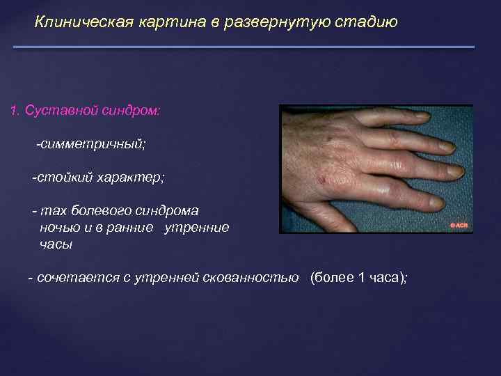 Клиническая картина в развернутую стадию 1. Суставной синдром: -симметричный; -стойкий характер; - max болевого