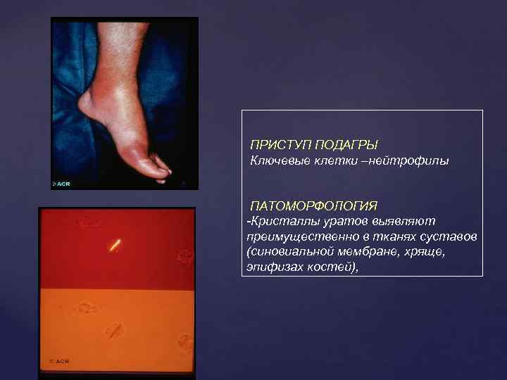 ПРИСТУП ПОДАГРЫ Ключевые клетки –нейтрофилы ПАТОМОРФОЛОГИЯ -Кристаллы уратов выявляют преимущественно в тканях суставов (синовиальной
