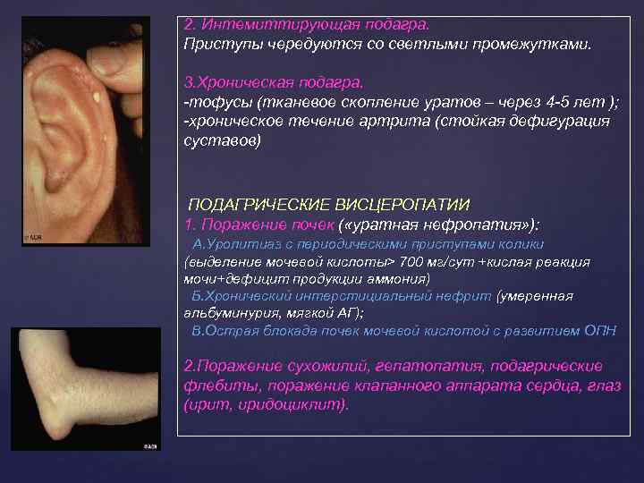 2. Интемиттирующая подагра. Приступы чередуются со светлыми промежутками. 3. Хроническая подагра. -тофусы (тканевое скопление