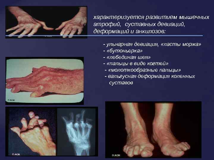 характеризуется развитием мышечных атрофий, суставных девиаций, деформаций и анкилозов: - ульнарная девиация, «ласты моржа»