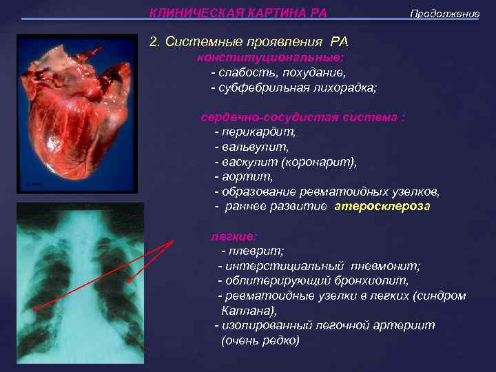 КЛИНИЧЕСКАЯ КАРТИНА РА Продолжение 2. Системные проявления РА конституциональные: - слабость, похудание, - субфебрильная