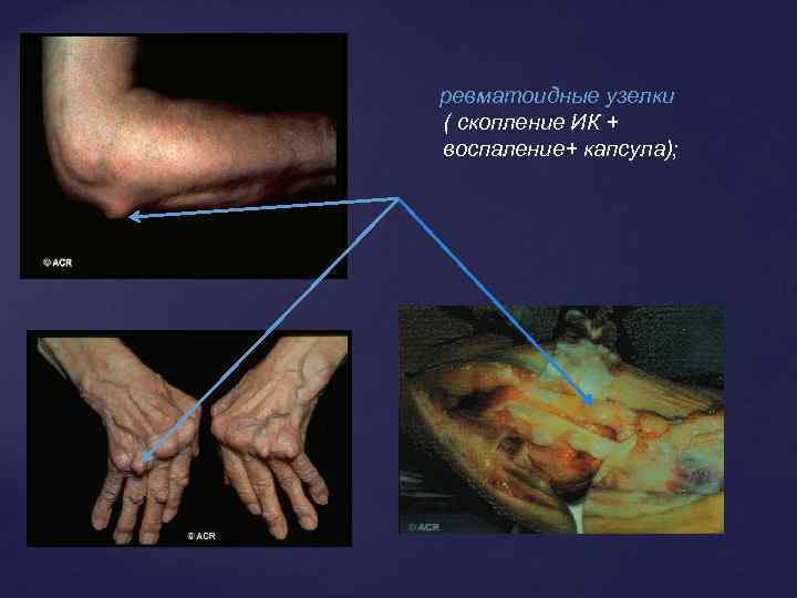 ревматоидные узелки ( скопление ИК + воспаление+ капсула); 