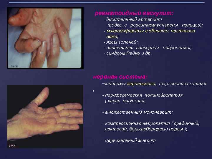 ревматоидный васкулит: - дигитальный артериит (редко с развитием гангрены пальцев); - микроинфаркты в области