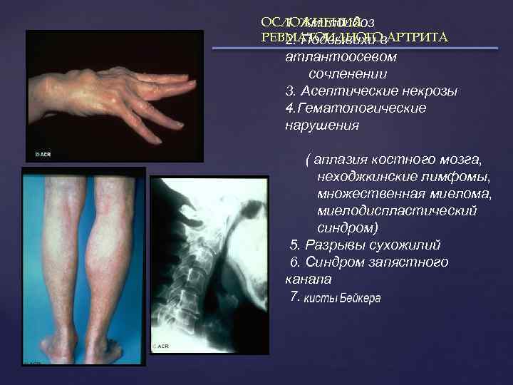 ОСЛОЖНЕНИЯ 1. Амилоидоз РЕВМАТОИДНОГО АРТРИТА 2. Подвывихи в атлантоосевом сочленении 3. Асептические некрозы 4.