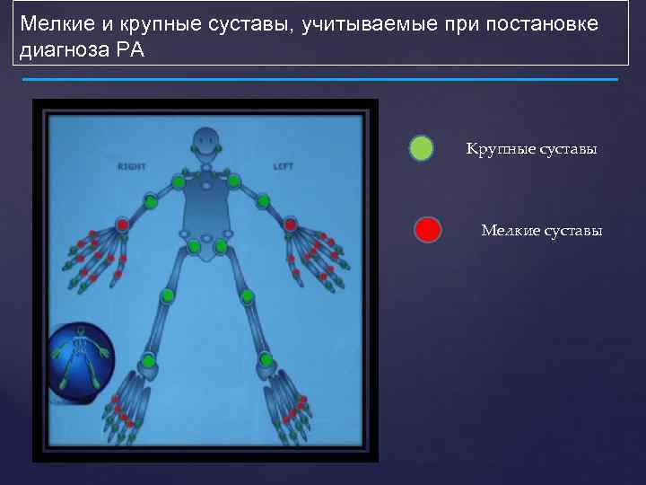Мелкие и крупные суставы, учитываемые при постановке диагноза РА Крупные суставы { Мелкие суставы