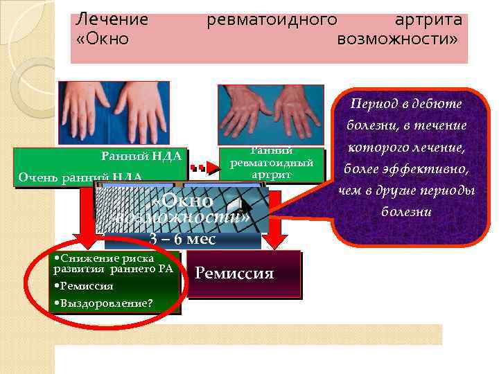 Лечение «Окно ревматоидного артрита возможности» Период в дебюте болезни, в течение Ранний ревматоидный артрит