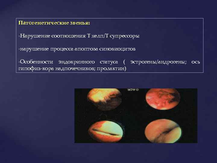 Патогенетические звенья: -Нарушение соотношения Т хелп/Т супрессоры -нарушение процесса апоптоза синовиоцитов -Особенности эндокринного статуса