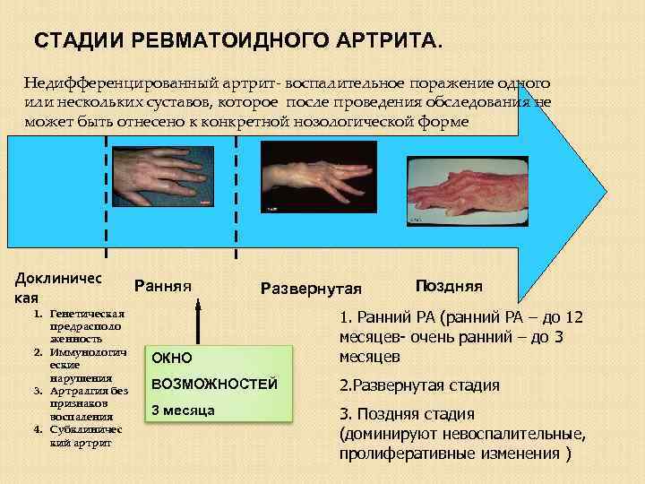 СТАДИИ РЕВМАТОИДНОГО АРТРИТА. Недифференцированный артрит- воспалительное поражение одного или нескольких суставов, которое после проведения
