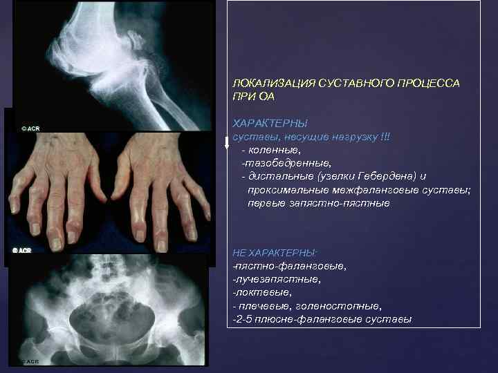 ЛОКАЛИЗАЦИЯ СУСТАВНОГО ПРОЦЕССА ПРИ ОА ХАРАКТЕРНЫ суставы, несущие нагрузку !!! - коленные, -тазобедренные, -