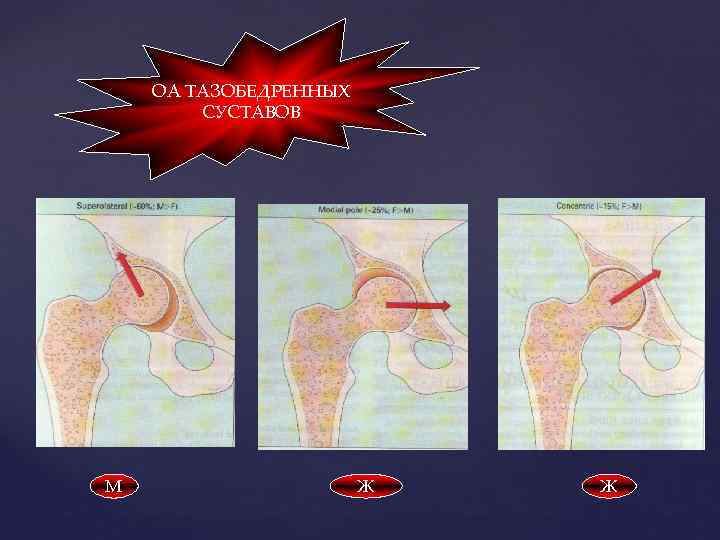 ОА ТАЗОБЕДРЕННЫХ СУСТАВОВ М Ж Ж 
