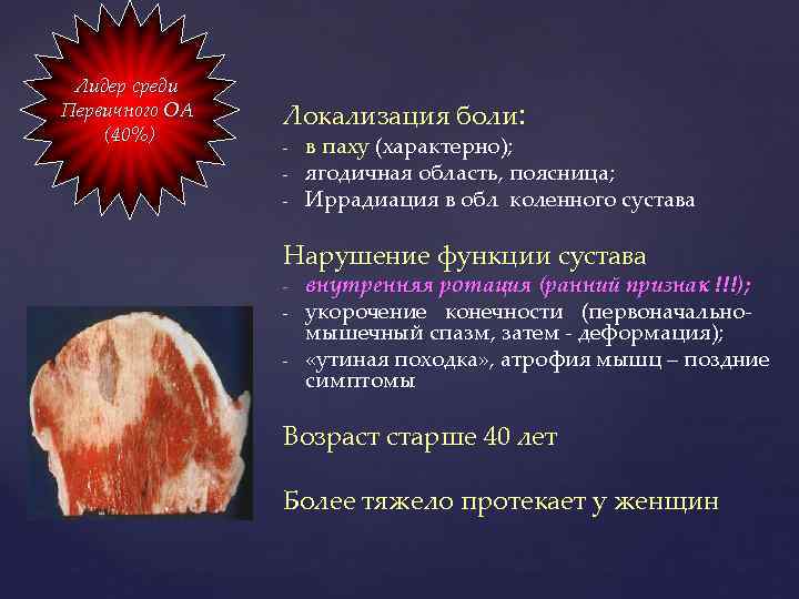 Лидер среди Первичного ОА (40%) Локализация боли: - в паху (характерно); ягодичная область, поясница;