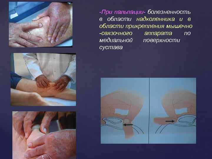 -При пальпации- болезненность в области надколенника и в области прикрепления мышечно -связочного аппарата по