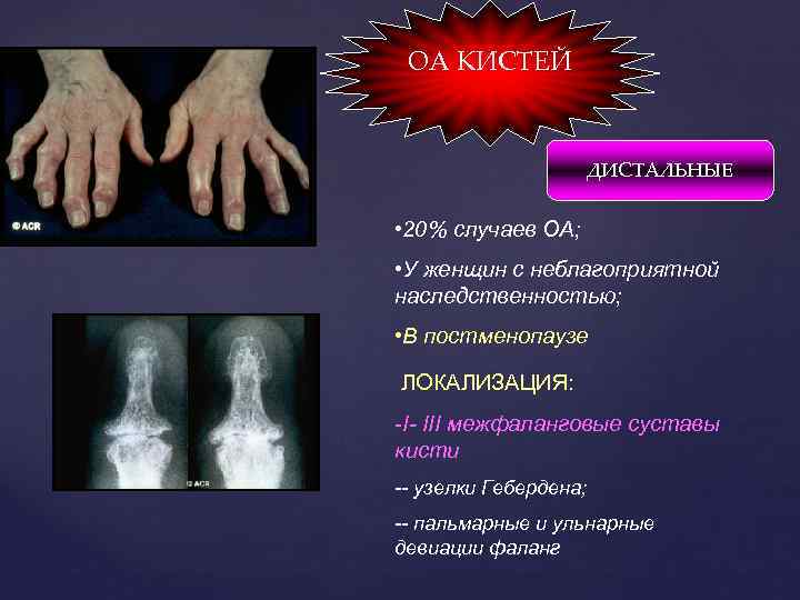 ОА КИСТЕЙ ДИСТАЛЬНЫЕ • 20% случаев ОА; • У женщин с неблагоприятной наследственностью; •