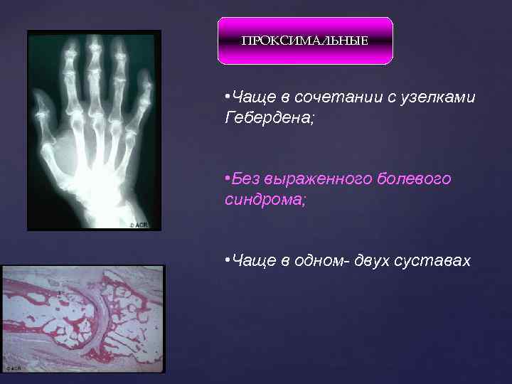 ПРОКСИМАЛЬНЫЕ • Чаще в сочетании с узелками Гебердена; • Без выраженного болевого синдрома; •