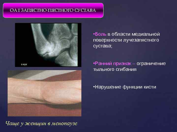 ОА I ЗАПЯСТНО-ПЯСТНОГО СУСТАВА • Боль в области медиальной поверхности лучезапястного сустава; • Ранний