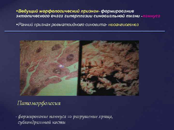  Ведущий морфологический признак- формирование эктопического очага гиперплазии синовиальной ткани -паннуса Ранний признак ревматоидного