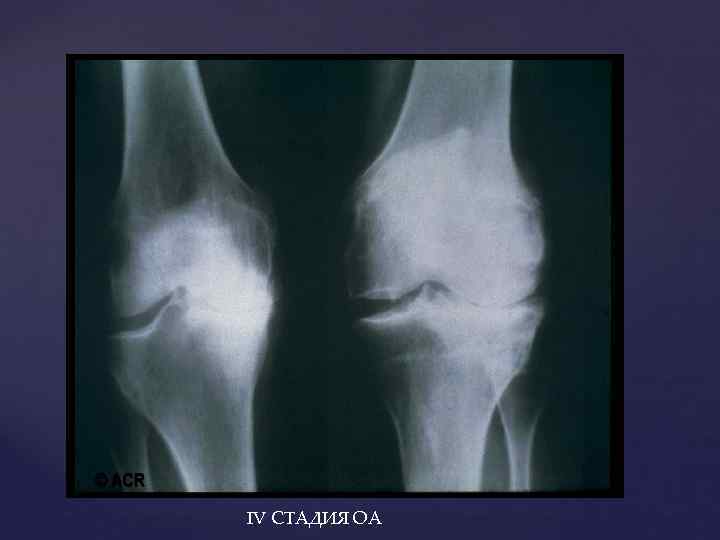 IV СТАДИЯ ОА 