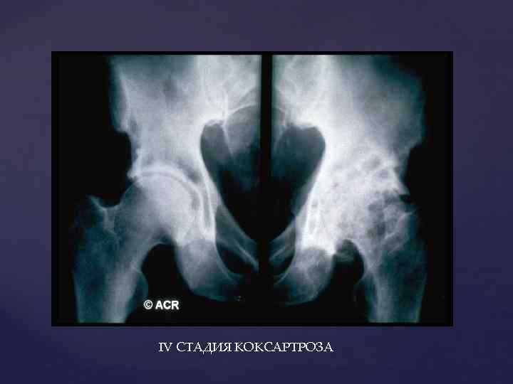 IV СТАДИЯ КОКСАРТРОЗА 