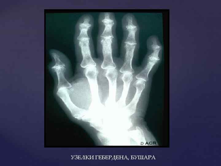 УЗЕЛКИ ГЕБЕРДЕНА, БУШАРА 