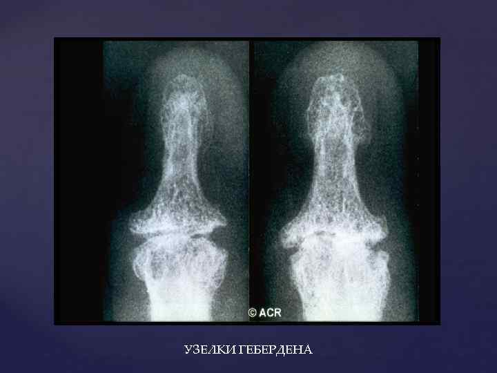 УЗЕЛКИ ГЕБЕРДЕНА 