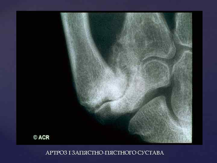 АРТРОЗ I ЗАПЯСТНО-ПЯСТНОГО СУСТАВА 