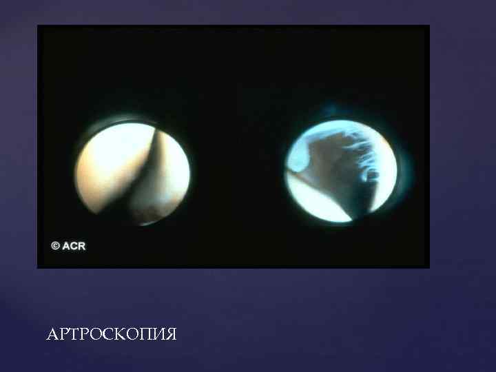 АРТРОСКОПИЯ 