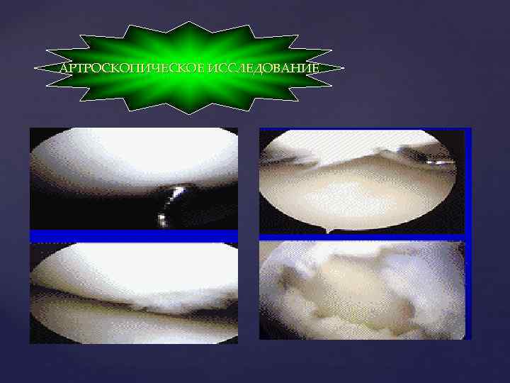 АРТРОСКОПИЧЕСКОЕ ИССЛЕДОВАНИЕ 