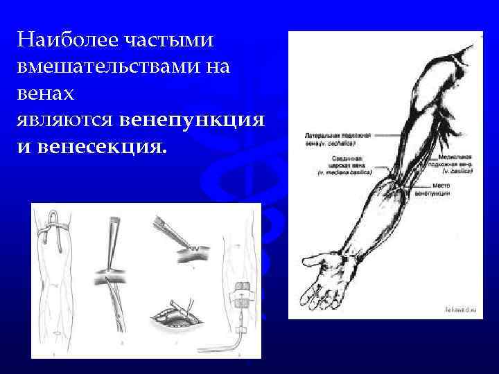 Наиболее частыми вмешательствами на венах являются венепункция и венесекция. 