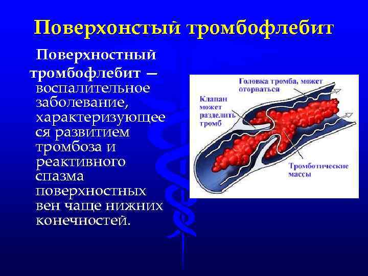 Поверхонстый тромбофлебит Поверхностный тромбофлебит — воспалительное заболевание, характеризующее ся развитием тромбоза и реактивного спазма