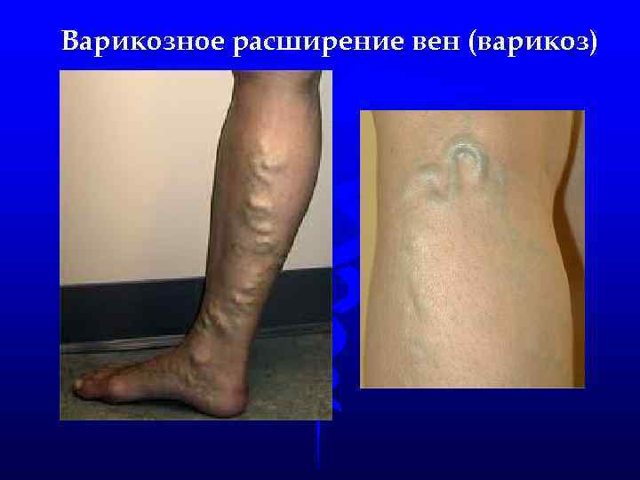 Варикозное расширение вен (варикоз) 
