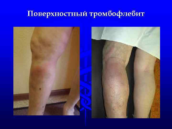 Поверхностный тромбофлебит 