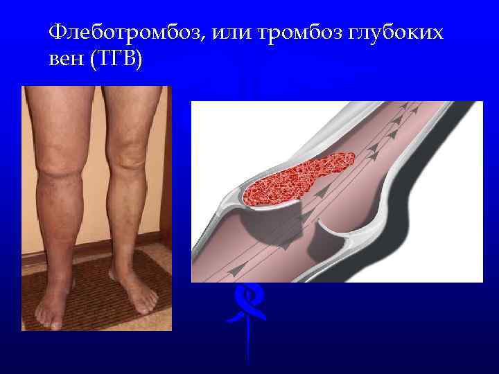 Флеботромбоз, или тромбоз глубоких вен (ТГВ) 