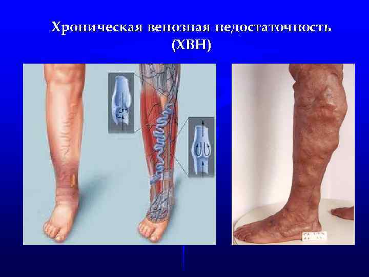 Хроническая венозная недостаточность (ХВН) 
