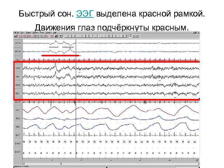 Быстрый сон. ЭЭГ выделена красной рамкой. Движения глаз подчёркнуты красным. 