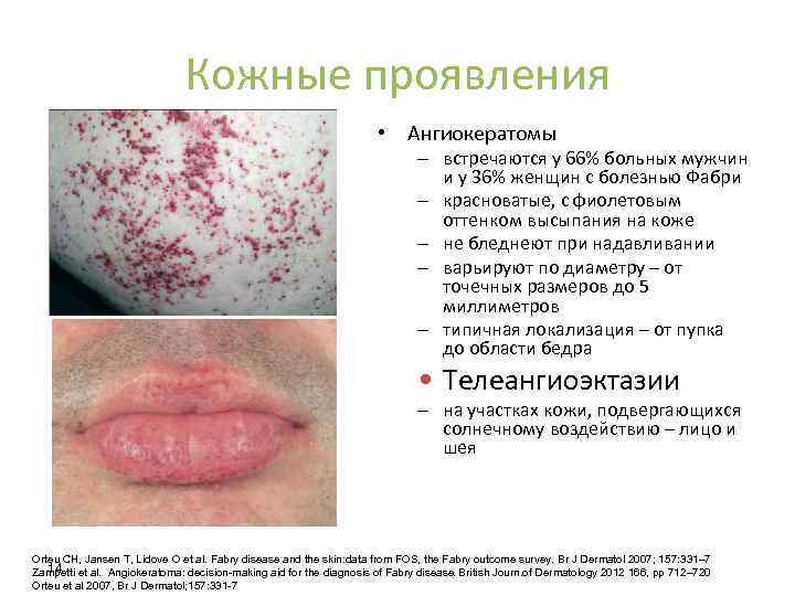 Кожные проявления • Ангиокератомы – встречаются у 66% больных мужчин и у 36% женщин