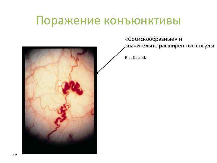 Поражение конъюнктивы «Сосискообразные» и значительно расширенные сосуды R. J. Desnick 17 