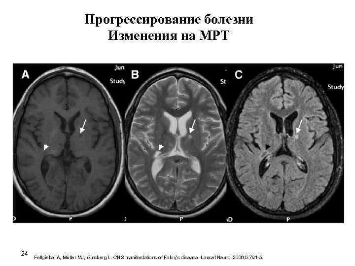 Прогрессирование болезни Изменения на МРТ 24 Fellgiebel A, Müller MJ, Ginsberg L. CNS manifestations