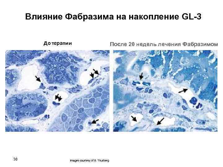 Влияние Фабразима на накопление GL-3 До терапии После 20 недель лечения Фабразимом GL-3 clearance