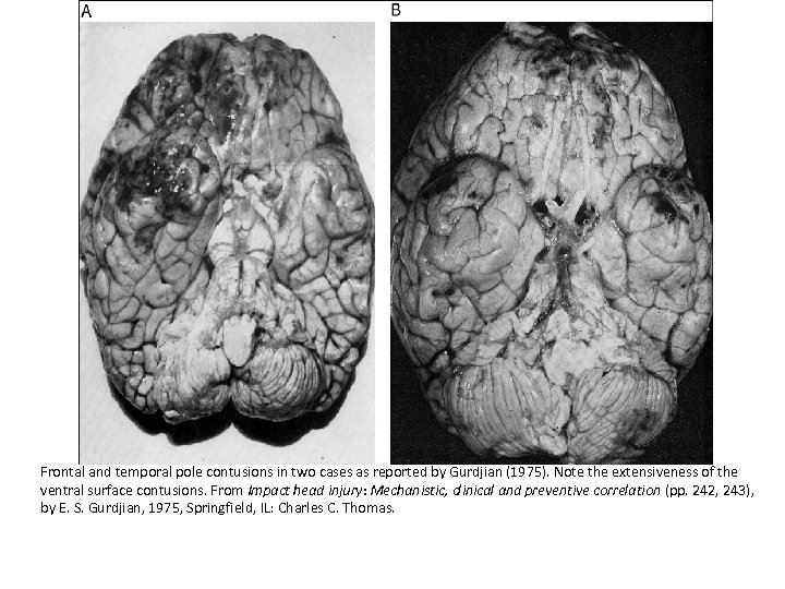 Frontal and temporal pole contusions in two cases as reported by Gurdjian (1975). Note