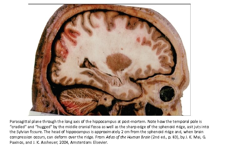 Parasagittal plane through the long axis of the hippocampus at post-mortem. Note how the