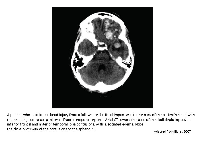 A patient who sustained a head injury from a fall, where the focal impact
