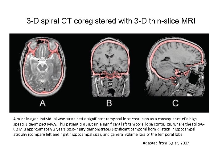 3 -D spiral CT coregistered with 3 -D thin-slice MRI A middle-aged individual who