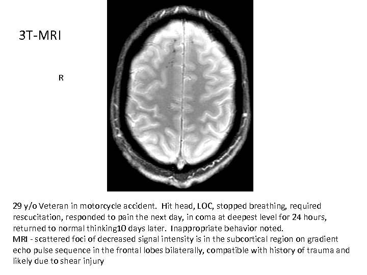 3 T-MRI R 29 y/o Veteran in motorcycle accident. Hit head, LOC, stopped breathing,