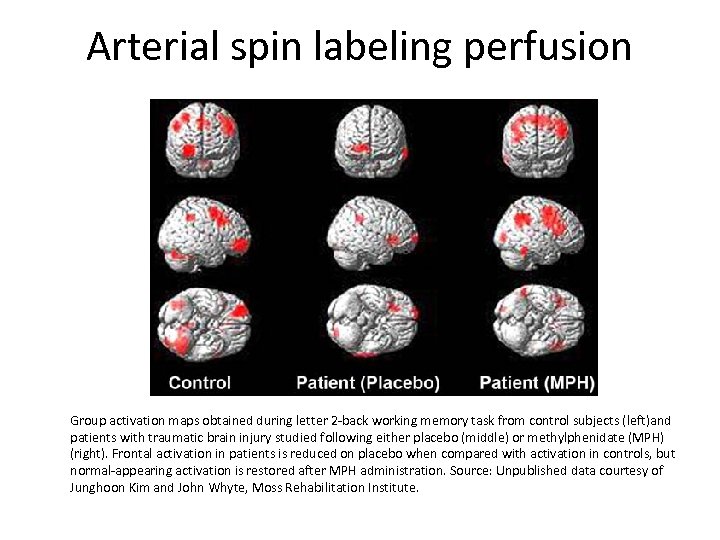 Arterial spin labeling perfusion Group activation maps obtained during letter 2 -back working memory