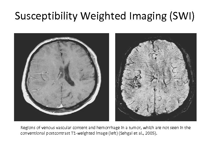 Susceptibility Weighted Imaging (SWI) Regions of venous vascular content and hemorrhage in a tumor,