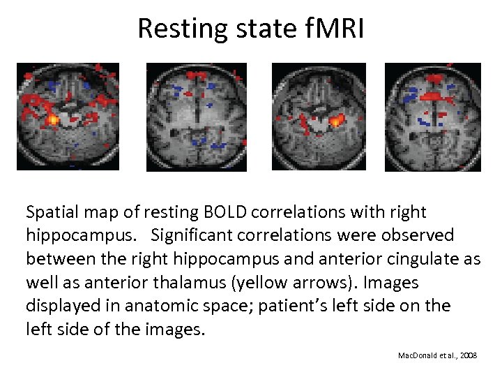 Resting state f. MRI Spatial map of resting BOLD correlations with right hippocampus. Significant