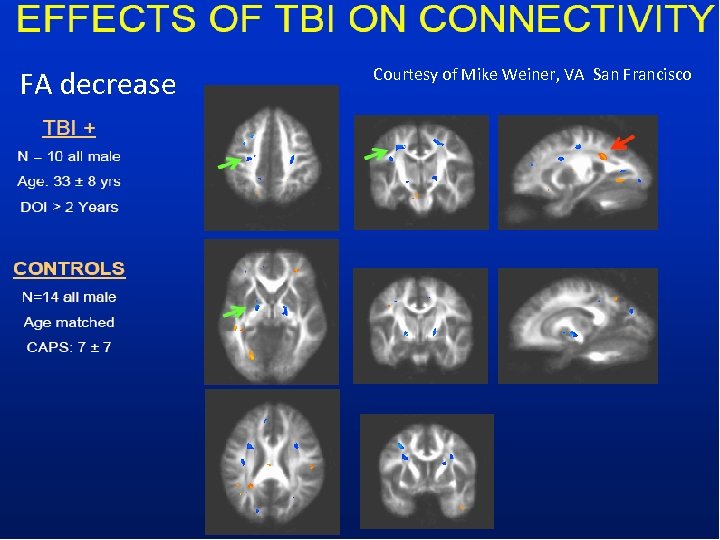 FA decrease Courtesy of Mike Weiner, VA San Francisco 