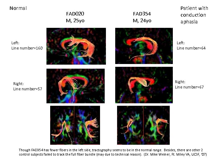Normal Left: Line number=160 Right: Line number=57 FAD 020 M, 25 yo FAD 354