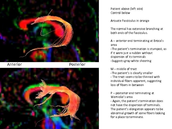 A Patient above (left side) Control below M Arcuate Fasciculus in orange The normal